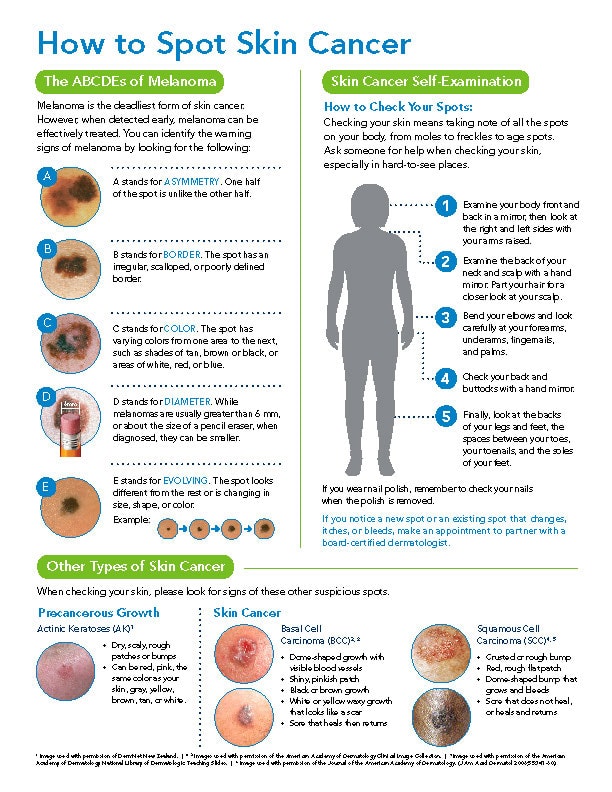 How To Spot Skin Cancer Infographic